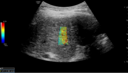 LOGIQ E10 - Abdominal SWE Guide