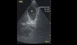 Vscan Case Study - Aids in the Diagnosis of a Pancreatic ...