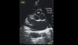 Vscan Case Study - Right Atrial Mass