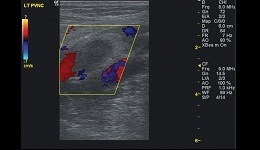 Vscan Case Study - Helps Reveal Pulmonary Embolism