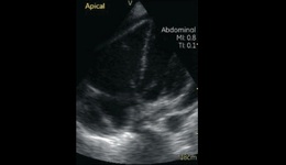 Vscan Case Study - Helps Detect Pericardial Effusion