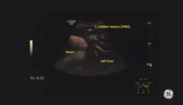 Dr. Höpfner - Volume Navigation with LOGIQ E9 - First steps