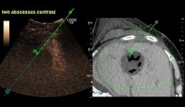 LOGIQ E9 Liver Abscess CT Fusion