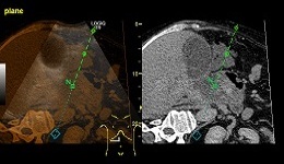 LOGIQ E9 Pancreatic Abscess US Overlay