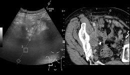 LOGIQ E9 Recurring Pelvic Tumor