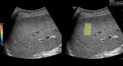 LOGIQ E9 - SWE Abdominal Imaging