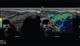 LOGIQ Strain Elastography Basics 