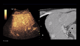 Dr. Franco Orsi - Benefits of Percutaneous Ablation over ...