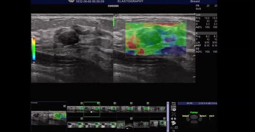 LOGIQ E9 - Strain Elastography 