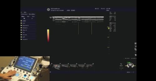 LOGIQ P9/P7- Color Quantification