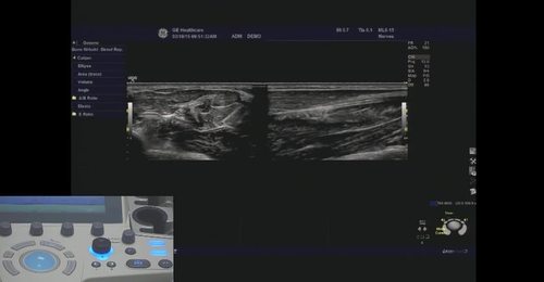 LOGIQ P9/P7- Split screen